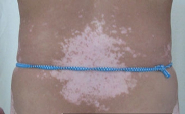 泛发型白癜风的危害有哪些