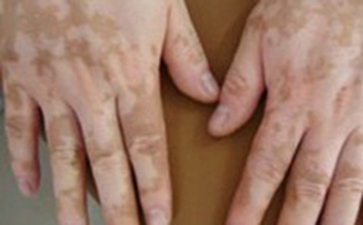 散发型白癜风病因有哪些