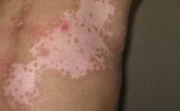 引发完全性白癜风的原因是什么