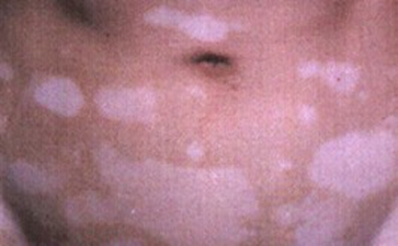 白癜风到底会不会遗传