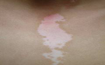 白癜风的食疗都是有哪些