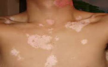 白癜风的预防措施有哪些