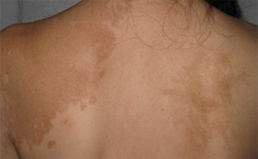 初期白癜风症状是什么