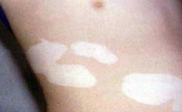 白癜风常见的病因有哪些