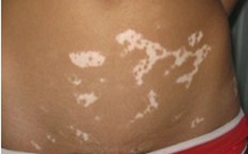 颈部白癜风有什那些特征