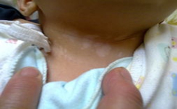 儿童白癜风的原因有什么