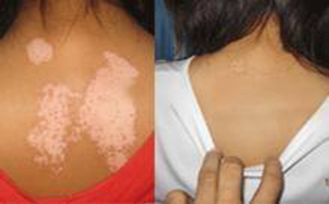 泛发型白癜风有哪些症状表现