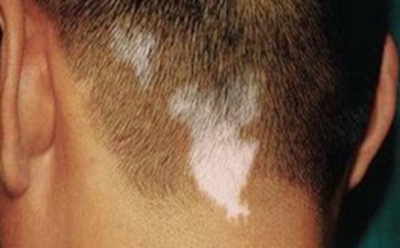 散发型白癜风的危害有哪些