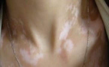 全身型白癜风危害到底有多大