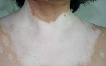 白癜风对患者有哪些危害