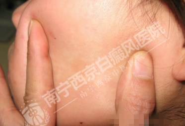 DZ-GFX 2017/6/9 星期五 下午 1:31:02表现为白斑的皮肤病有哪些?