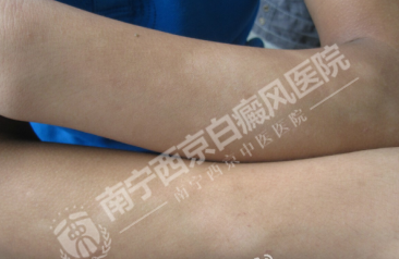 DZ-GFX 2017/6/9 星期五 下午 1:31:02表现为白斑的皮肤病有哪些?