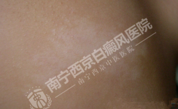 DZ-GFX 2017/6/9 星期五 下午 1:31:02表现为白斑的皮肤病有哪些?