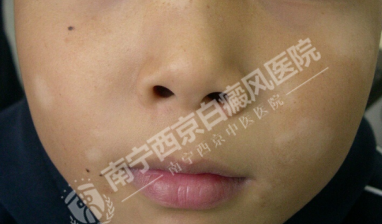 DZ-GFX 2017/6/9 星期五 下午 1:31:02表现为白斑的皮肤病有哪些?