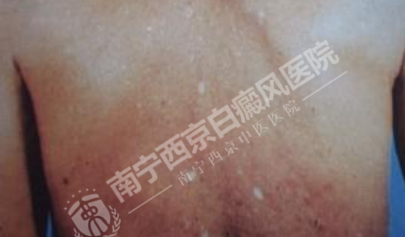 DZ-GFX 2017/6/9 星期五 下午 1:31:02表现为白斑的皮肤病有哪些?