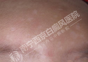 DZ-GFX 2017/6/9 星期五 下午 1:31:02表现为白斑的皮肤病有哪些?