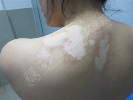 DZ-GFX 2017/6/9 星期五 下午 1:31:02表现为白斑的皮肤病有哪些?