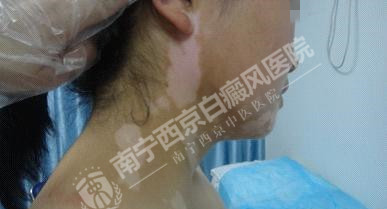 DZ-GFX 2017/6/9 星期五 下午 1:31:02表现为白斑的皮肤病有哪些?