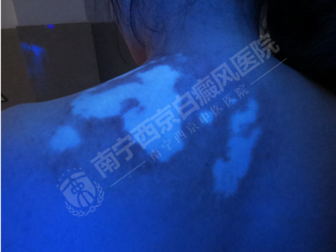 哪些护理措施有助于白癜风患者康复?