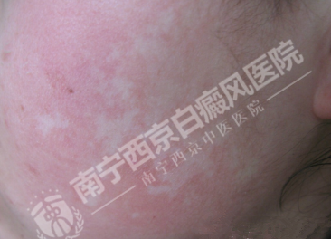 DZ-GFX 2017/6/9 星期五 下午 1:31:02表现为白斑的皮肤病有哪些?