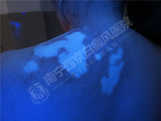 DZ-GFX 2017/6/9 星期五 下午 1:31:02表现为白斑的皮肤病有哪些?