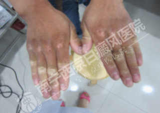 DZ-GFX 2017/6/9 星期五 下午 1:31:02表现为白斑的皮肤病有哪些?