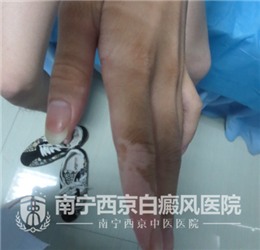 刘丰(化名),男 ,21岁