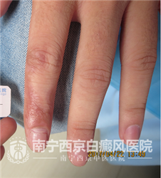 刘丰(化名),男 ,21岁