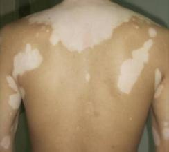 白癜风造成的危害