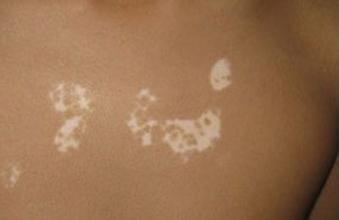 为什么白癜风难治疗