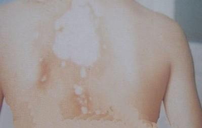 白癜风患者心理压力大怎么办