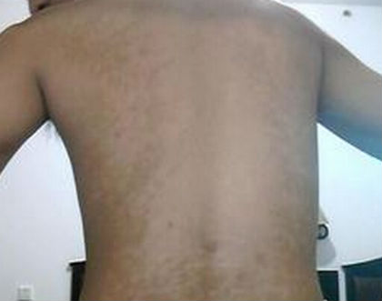 如何预防白癜风发生