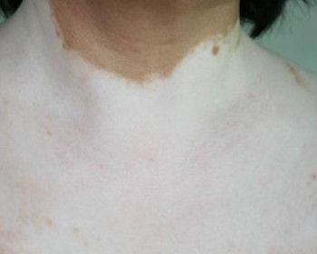 白癜风会遗传下一代