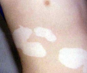 预防白癜风的好方法