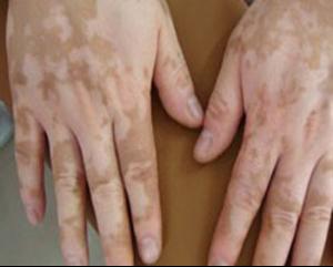 白癜风患者如何科学饮食