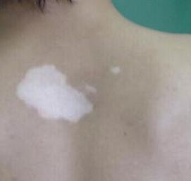 得白癜风的特征