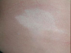 饮食如何诱导孩子患上白癜风