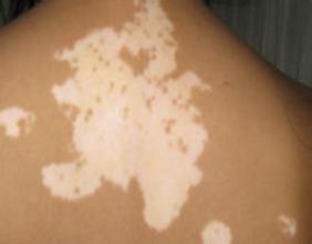 白癜风为什么越来越严重