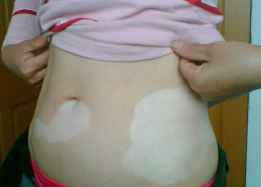 如何判断孩子患白癜风