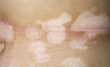 哪些因素延长白癜风恢复