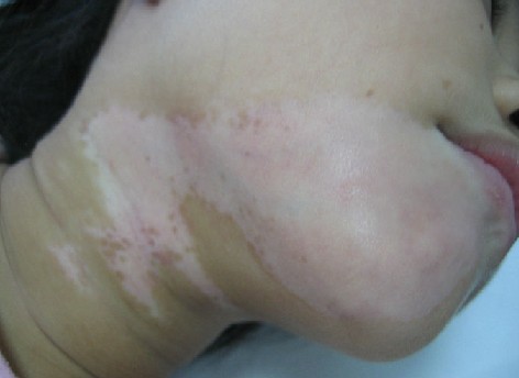 患上白癜风怎么护理