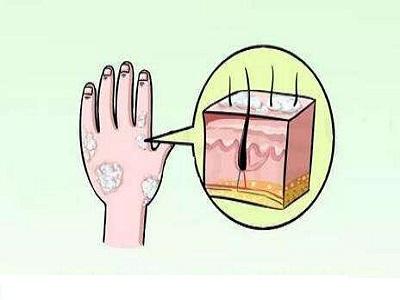 白癜风涂抹药物有哪些影响