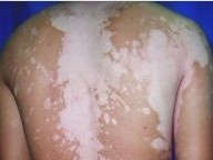 哪些和白癜风发生有关