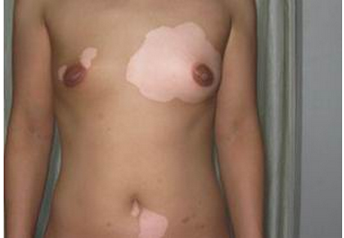 ¶ùͯ»¼Éϰ×ñ°·ç