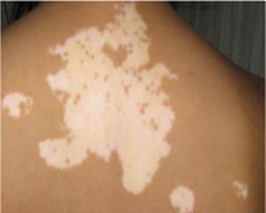 白癜风白斑怎么治疗