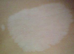 白癜风怎么接受治疗