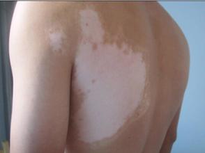 白癜风哪些需要了解