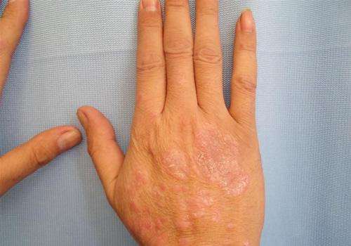 老年白癜风治疗方法