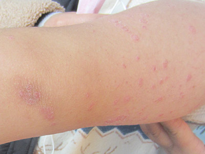 白癜风有什么样的危害