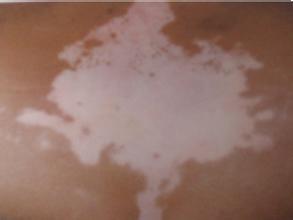 不小心被白癜风纠缠有什么样的危害